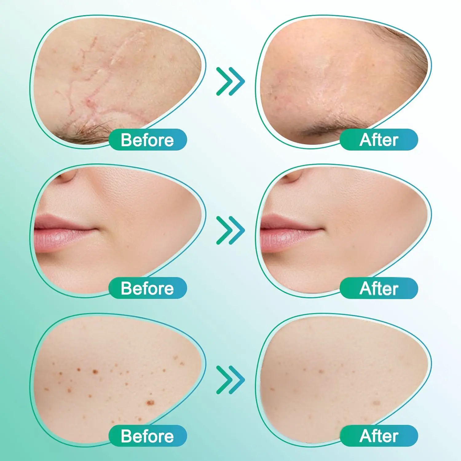 𝗖𝗮𝗿𝗲𝗕𝗿𝗲𝗲𝘇𝗲® 3-in-1 mikroadatas kopšanas plāksteris - Image 5